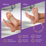 Aesta 3-Step Foot Peel Mask Treatment Kit for Dry Cracked Feet, Callus Remover, Baby Soft Feet, Vegan Foot Care