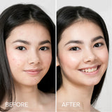 Acne Pimple Patches – Hydrocolloid Spot Treatment, Cute Blemish Care, Fast Acting Overnight- hydrocolloid treatment, tea tree extract, sensitive skin safe