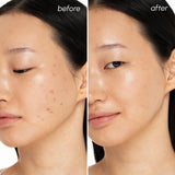 Witch Hazel Clearing Pads for Blemish Control & Gentle Exfoliation, pore refining, oil balancing, skin soothing