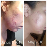 Super Acne Fighter - Organic Acne Treatment