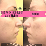Super Acne Fighter - Organic Acne Treatment